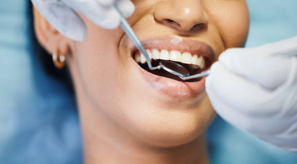 Teeth Whitening in CA